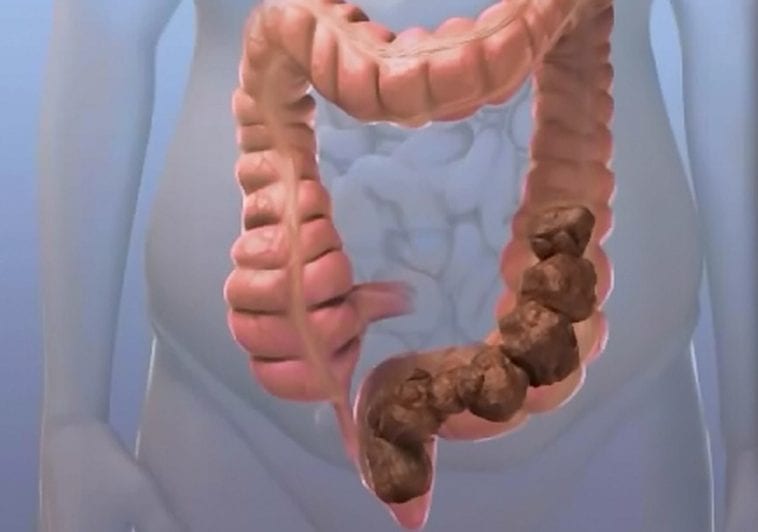 Constipação intestinal - Pelvis Care