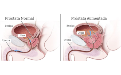 Tratamento da próstata e incontinência